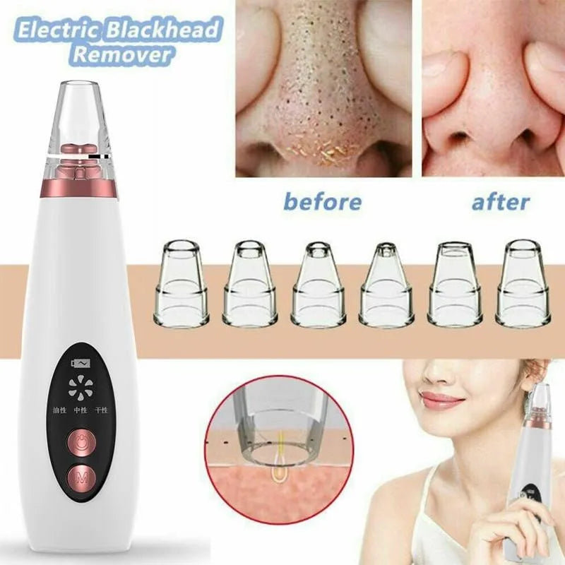 Smooth clear skin after using blackhead remover vacuum
